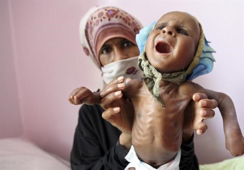 گزارش ایندیپندنت از سوءتغذیه وحشتناک بچه ها یمنی