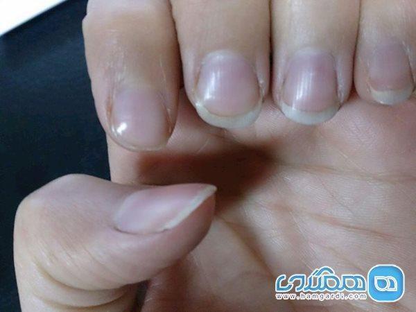 تشخیص سرطان ریه از روی شرایط ناخن ها