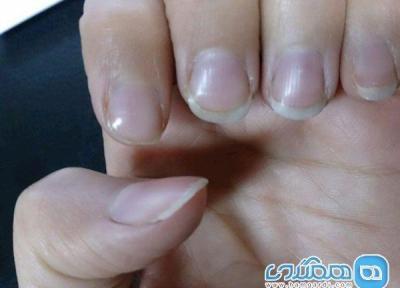 تشخیص سرطان ریه از روی شرایط ناخن ها